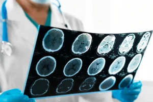 Traumatic Brain Injury Workers’ Compensation Settlements